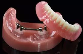 Bar Retained Denture